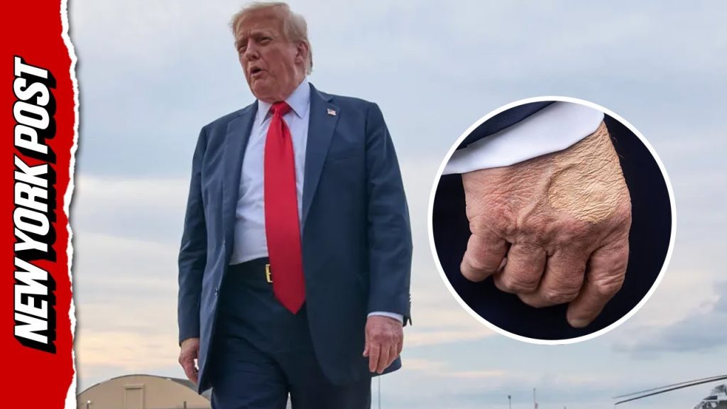 Trump health scare: Swollen legs and bruised hands –Leavitt reveals what’s going on
